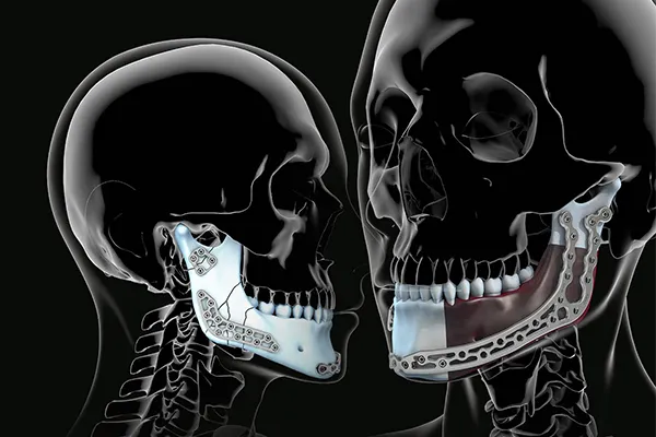 Real Surgycal Medartis mandíbula